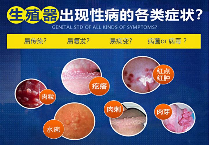 尖锐湿疣患者在饮食上应该注意什么